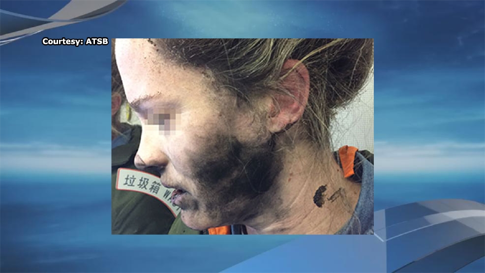 Woman burned after headphones explode on flight to Australia WBFF